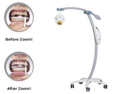 Tẩy trắng răng công nghệ Zoom 2