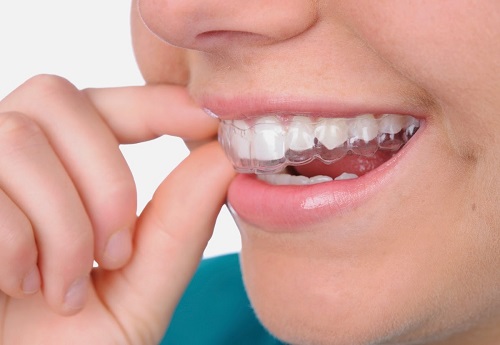 Tẩy trắng răng tại nhà với thuốc Opalescence 2