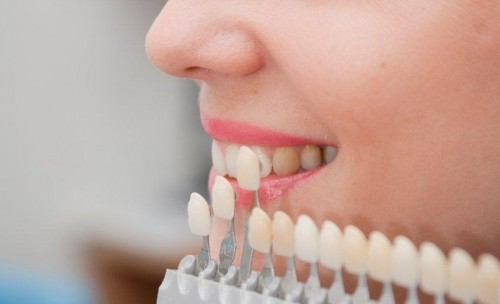 Tẩy trắng răng có duy trì được hiệu quả lâu dài?