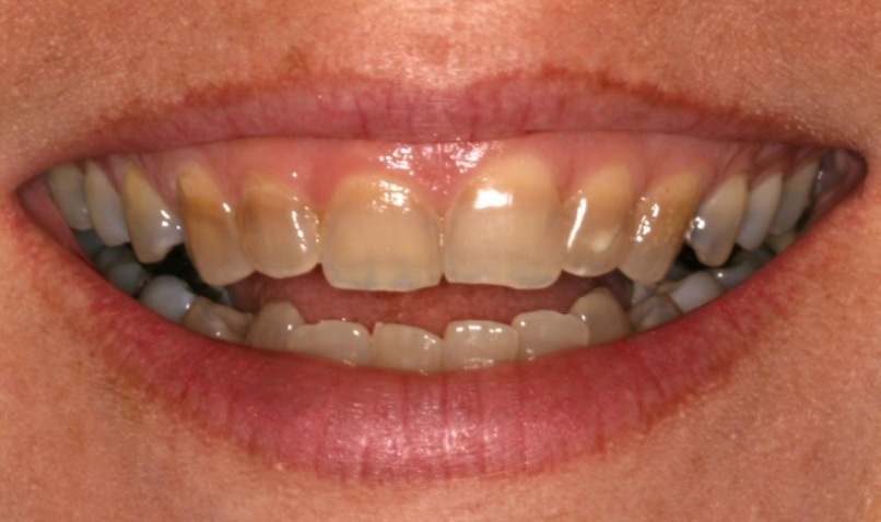 Tẩy trắng răng nhiễm Tetracycline