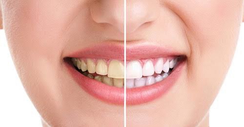 Tẩy trắng răng tại nhà với máng tẩy trắng 1