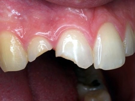 Cách giải quyết khi răng cửa bị sứt mẻ 