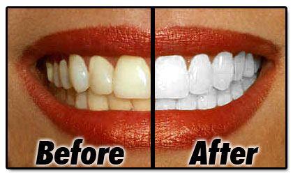 Dịch vụ tẩy trắng răng nào có chi phí thấp nhất? 