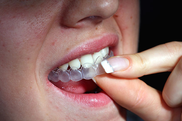 Tẩy trắng răng có lợi và hại gì?