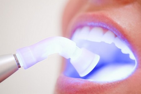  tẩy trắng răng tại nha khoa với đèn laser, plasma