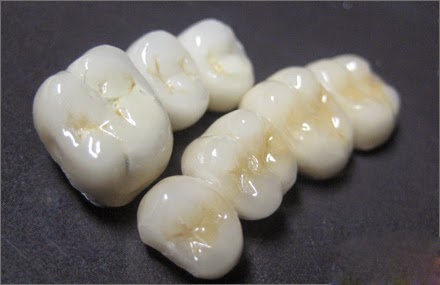 Răng sứ titan có bền hay không? 