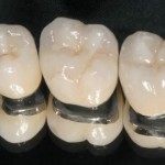 Răng sứ titan có bền hay không?