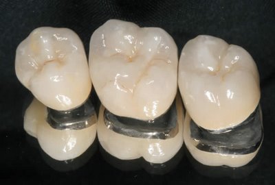 Răng sứ titan có bền hay không? 