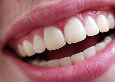 Sử dụng răng sứ phục hình răng vĩnh viễn sứt mẻ 