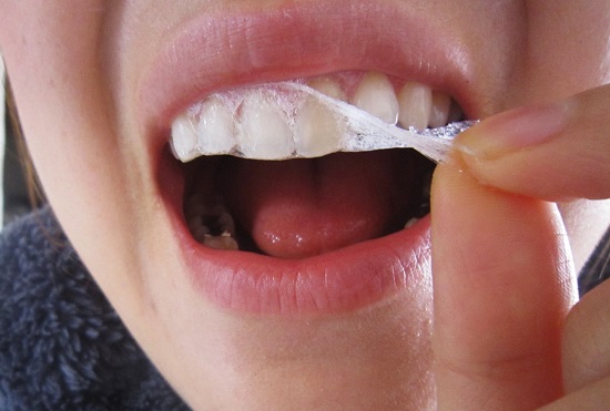 Những trường hợp tẩy trắng răng không thành công