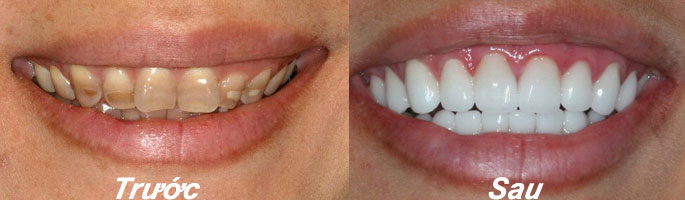 Phương pháp cải thiện tình trạng răng nhiễm màu