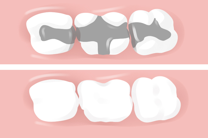 Hiệu quả khi sử dụng hợp chất composite trám răng