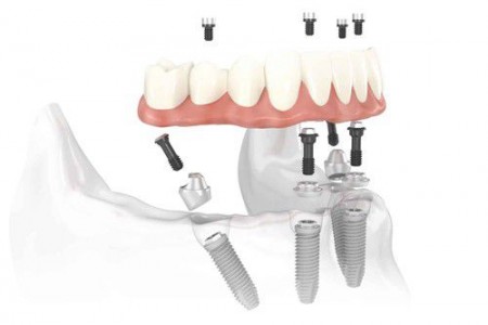 Những yếu tố làm nên thành công cho răng giả implant