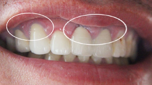 Tẩy trắng răng cho răng sứ 