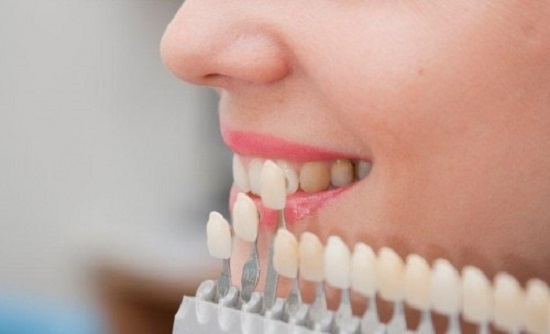 Tẩy trắng răng như thế nào để đẹp và an toàn?