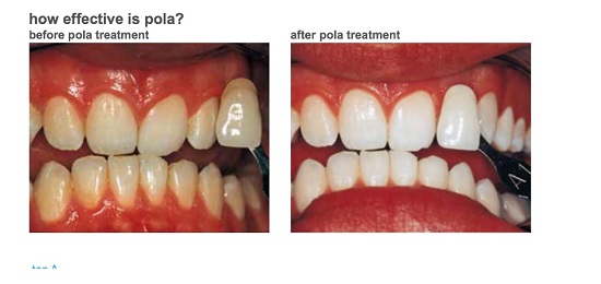 Ưu điểm của thuốc tẩy trắng răng Pola