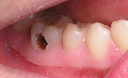 Những sai lầm thường gặp khi tẩy trắng răng 1