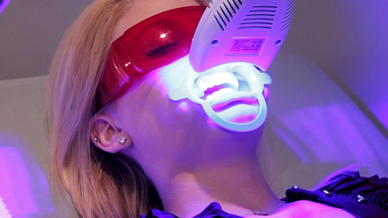 Tẩy trắng răng bằng ánh sáng laser