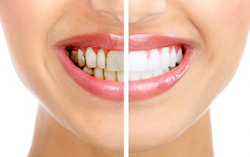 Tẩy trắng răng bằng đèn plasma có hại không? 2