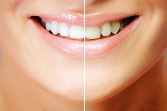 Tẩy trắng răng bằng Laser có giữ màu lâu không?