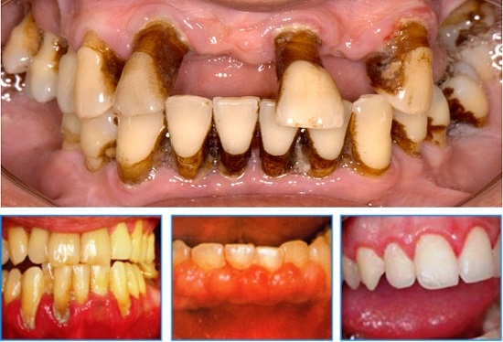 Có thể tẩy trắng răng khi đang chữa nha chu không?