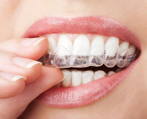 Dùng máng tẩy trắng răng trong bao lâu mới hiệu quả? 1