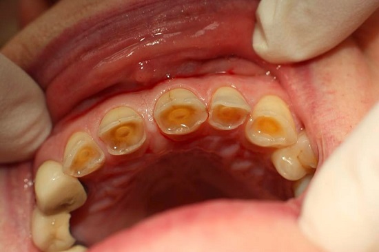 Tác hại của tẩy trắng răng không đúng cách