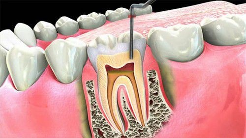 Quy trình tẩy trắng răng chết tủy 2