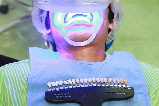 Tẩy trắng răng Laser Whitening giá bao nhiêu?