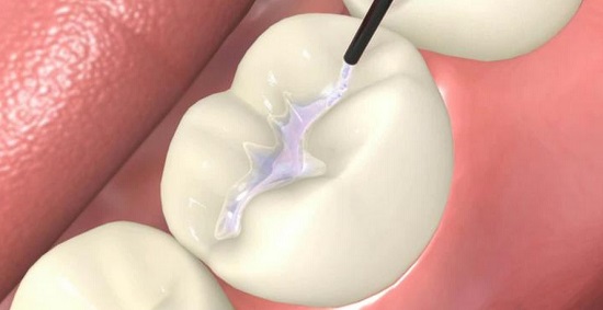 Đang bị sâu răng có tẩy trắng răng được không?