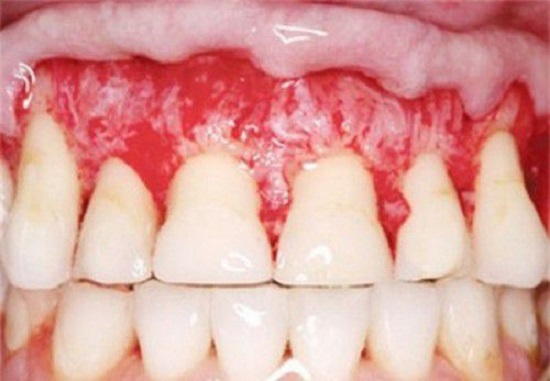 Tác hại của miếng dán tẩy trắng răng