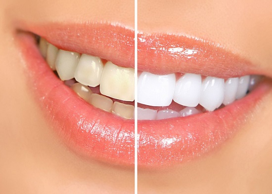 Thế nào là tẩy trắng răng an toàn?