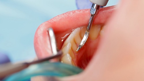 Những vấn đề cần biết về mảng bám răng 1