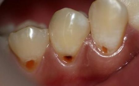 Bọc răng sứ cho răng sâu an toàn