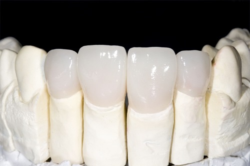 Răng sứ bị mòn - Nguyên nhân và cách khắc phục 3