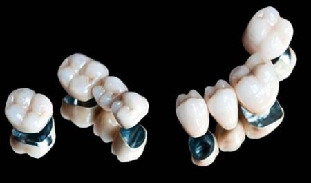 Bọc răng sứ titan có những ưu điểm gì?