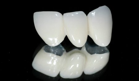 Bọc răng sứ titan giá bao nhiêu?