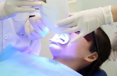 Công nghệ làm trắng răng an toàn