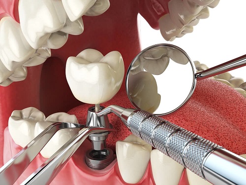 Dịch vụ cấy ghép răng implant tiêu chuẩn quốc tế 2