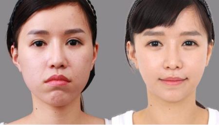 Dịch vụ phẫu thuật hàm móm an toàn