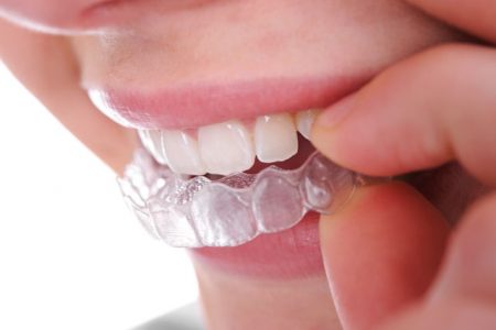 Làm sao để răng trắng nhanh