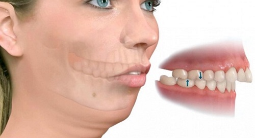 Phẫu thuật hàm hô không cần niềng răng 1