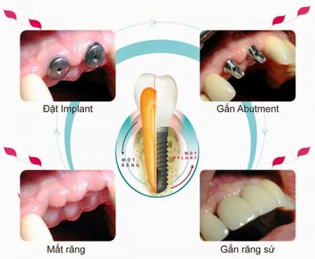 Phẫu thuật nâng xoang hàm trong cấy ghép răng implant