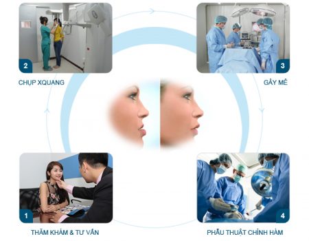 Quy trình phẫu thuật hàm hô như thế nào?