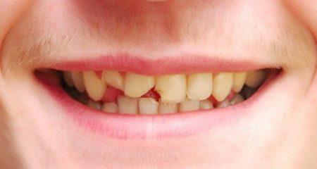 Răng sứ bị mẻ vỡ phải làm sao