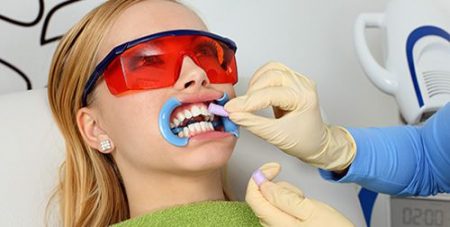 Tẩy trắng răng bằng laser whitening có hại không?