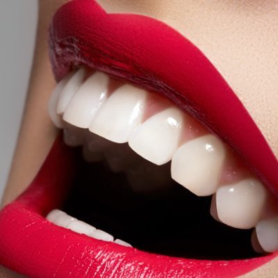 Tẩy trắng răng duy trì được trong bao lâu?