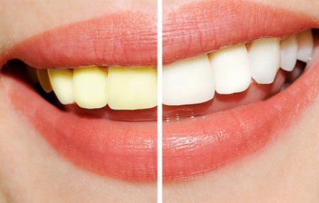 Tẩy trắng răng mất bao lâu thời gian
