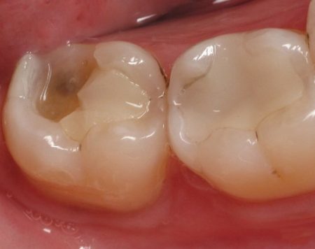 Trám răng khắc phục hậu quả răng bị sâu hiệu quả