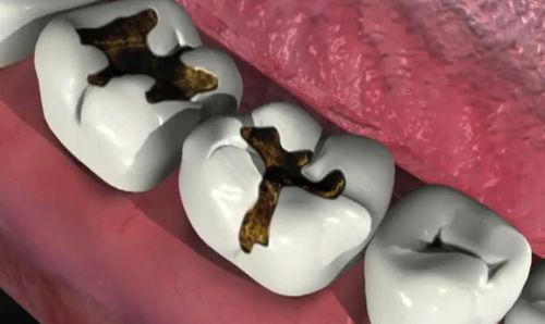Trám răng khắc phục hậu quả răng bị sâu hiệu quả